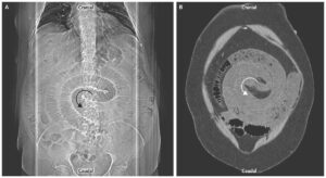 Read more about the article Swirl Sign – Intestinal Volvulus after Roux-en-Y Gastric Bypass