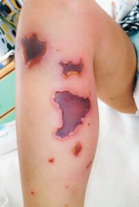 Read more about the article A 3-year-old Boy with Fever, Vomiting and Skin Lesions