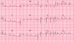Read more about the article ECG Case 100: Atrial Fibrillation and Pericarditis