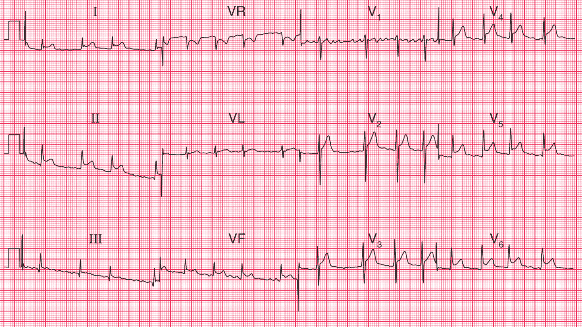 Atrial fibrillation; Widespread ST segment elevation, partly ‘high take-off’ but mainly due to pericarditis.