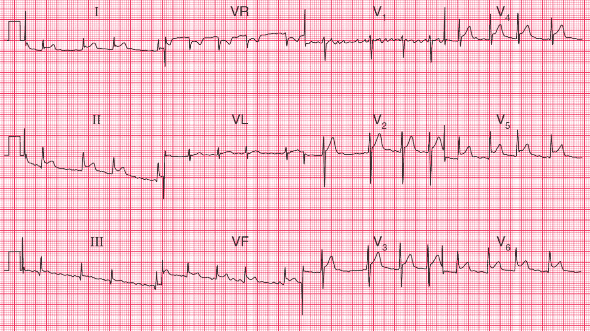 Read more about the article ECG Case 100