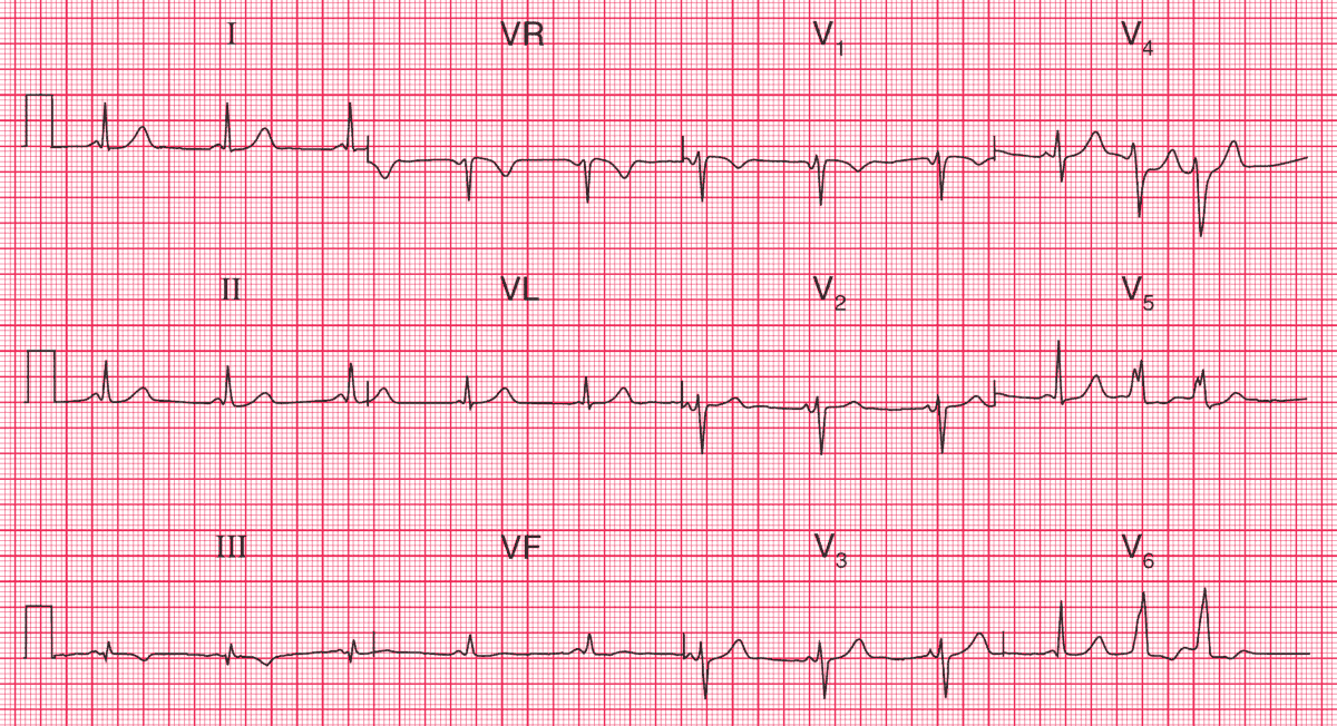Read more about the article ECG Case 101