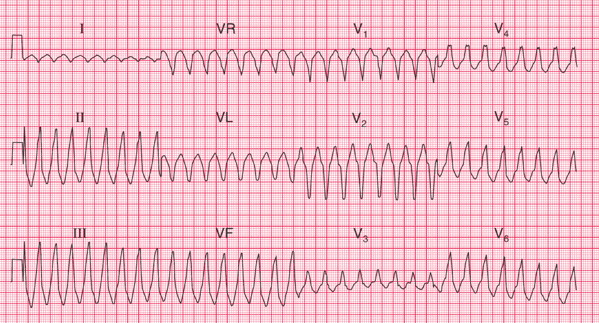Read more about the article ECG Case 102