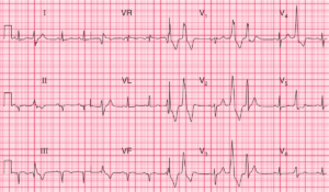 Read more about the article ECG Case 97: Old Inferior MI and Frequent Multifocal Ventricular Extrasystoles
