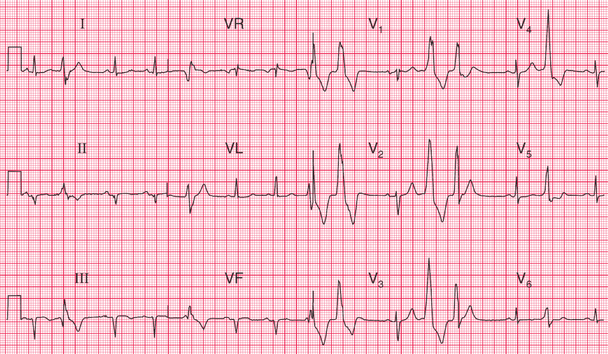 Read more about the article ECG Case 97