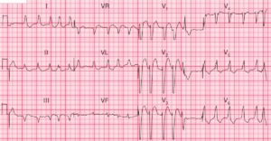 Read more about the article ECG Case 98: Atrial Fibrillation and LBBB in a patient with Dilated Cardiomyopathy