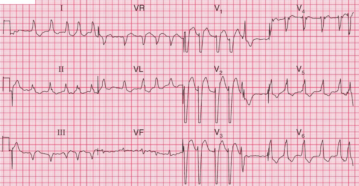 Atrial Fibrillation and LBBB in a patient with Dilated Cardiomyopathy