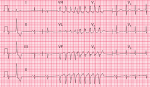 Read more about the article ECG Case 99: Sinus Rhythm with Paroxysmal Ventricular Tachycardia