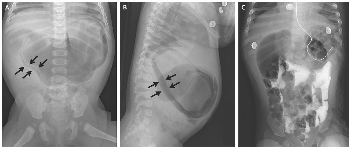 Gastric Pneumatosis Caused by Duodenal Obstruction