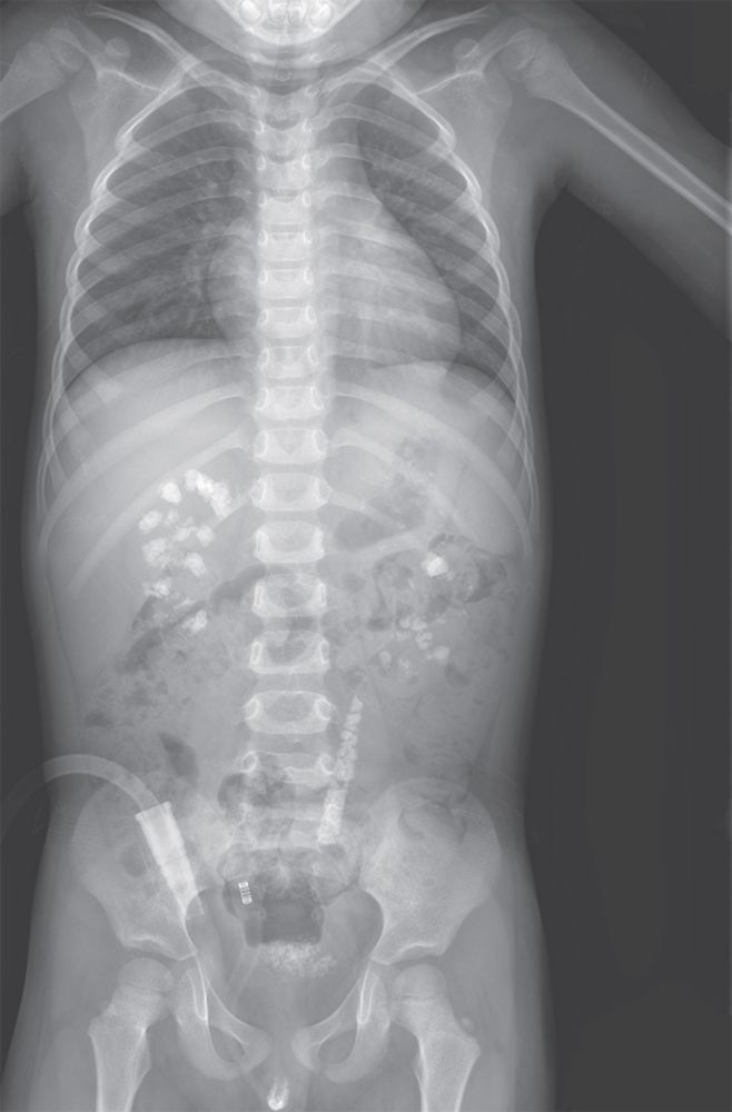 Read more about the article A 3-year-old Boy with Gross Hematuria and Intermittent Abdominal Pain