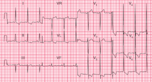 Read more about the article ECG Case 103: Left ventricular hypertrophy (LVH)