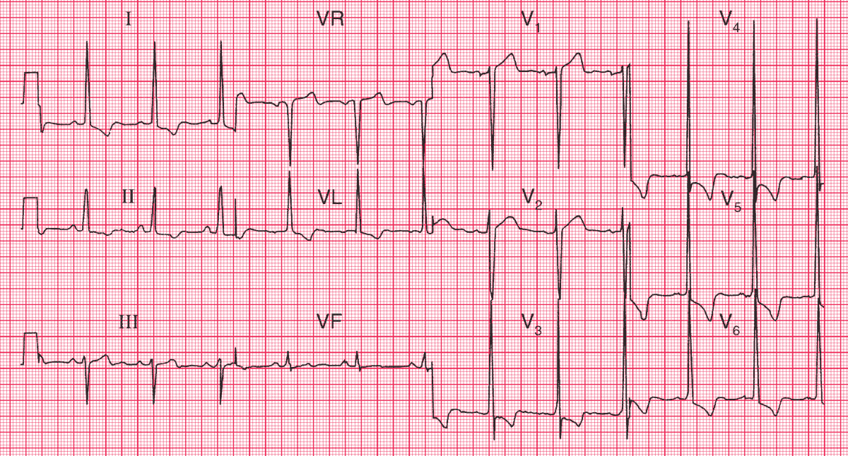 ST segment depression and Inverted T waves in leads I, II, VL, V3–V6 (Left ventricular strain pattern) indicating Left ventricular hypertrophy (LVH)