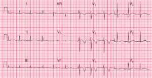 Read more about the article ECG Case 104: Congenital Long QT Syndrome