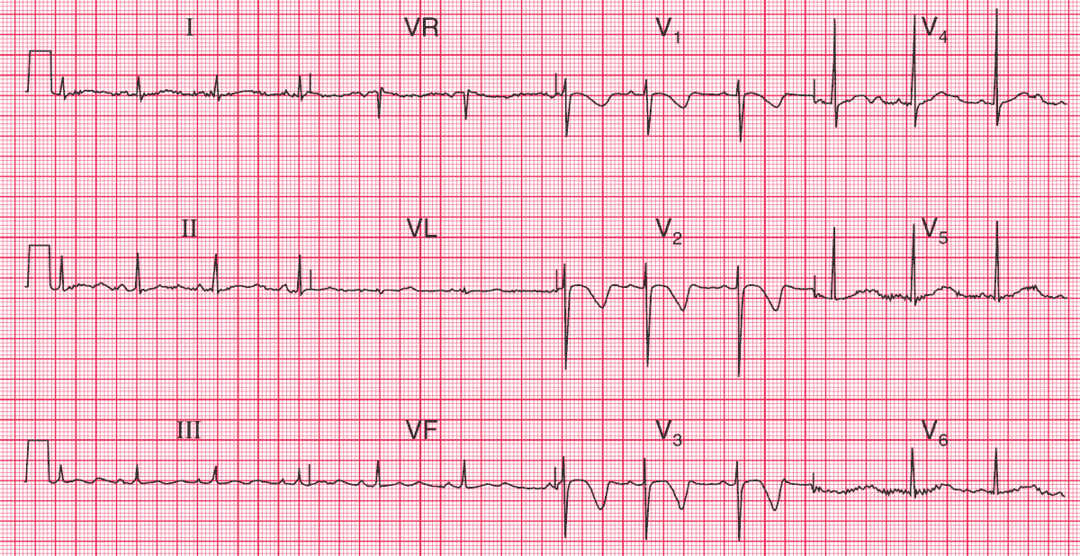 Read more about the article ECG Case 104