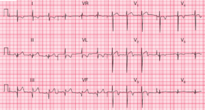 Read more about the article ECG Case 105: Inferior and Anterior MI