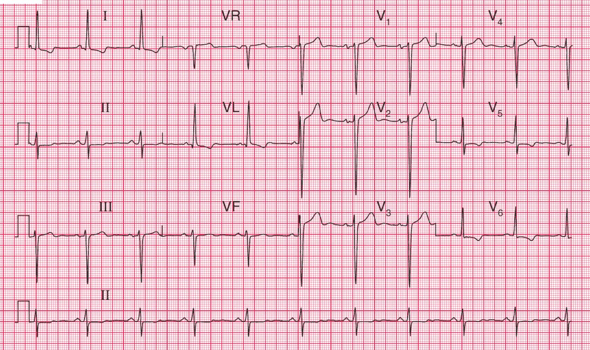 Read more about the article ECG Case 106