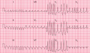 ECG Case 107: Atrial Fibrillation and WPW Syndrome - Manual of Medicine