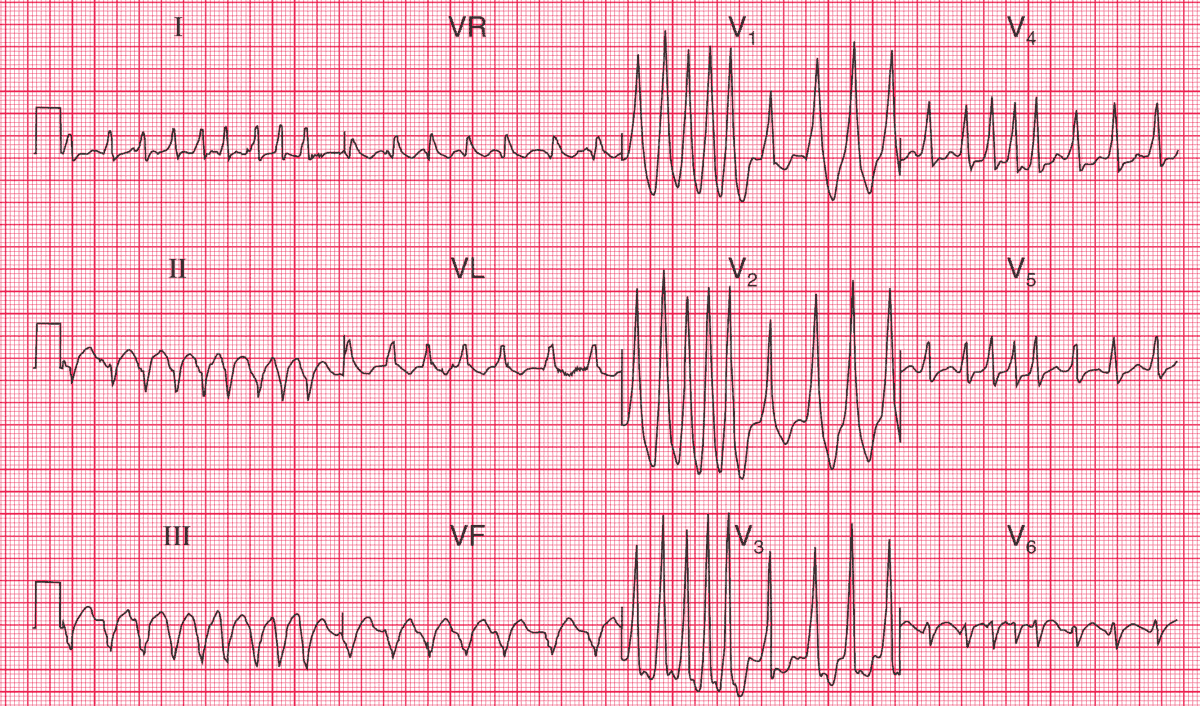 Atrial Fibrillation and WPW Syndrome