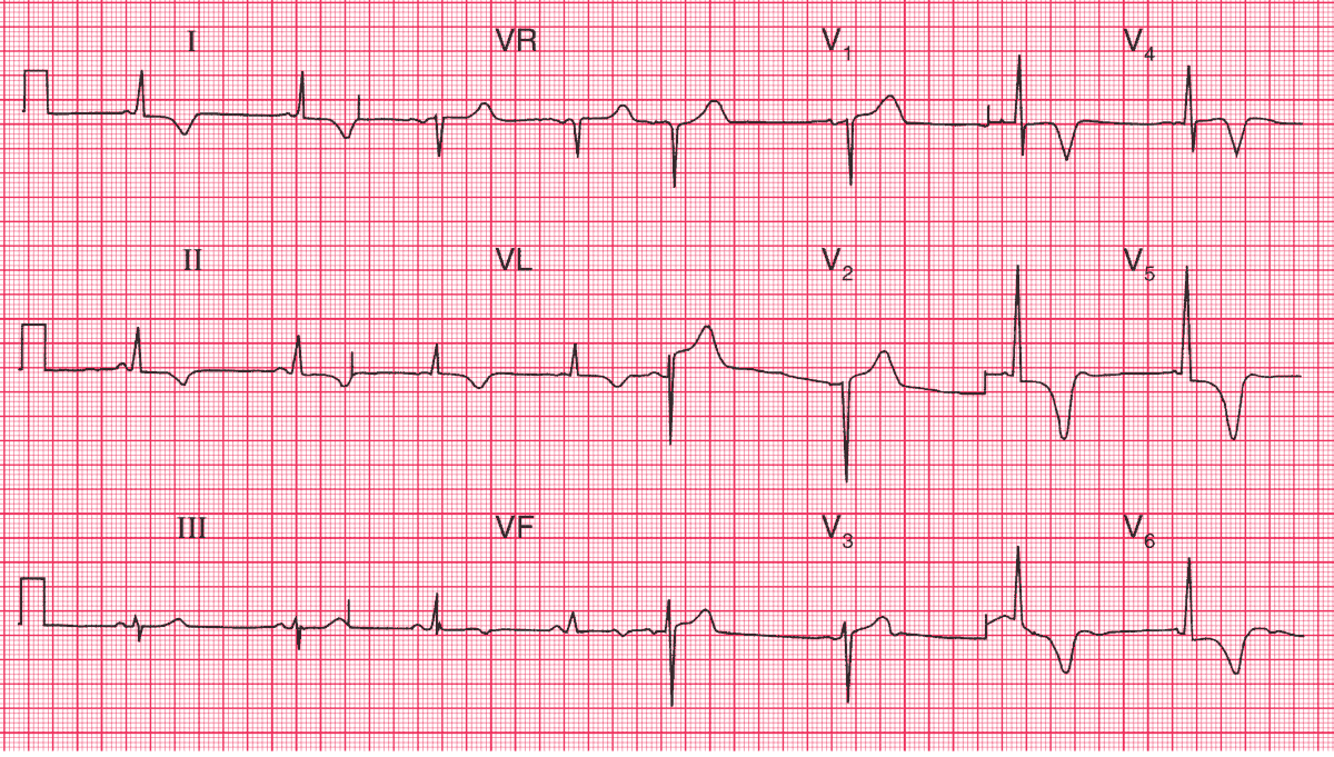 Gross T wave inversion in the anterolateral leads, suggesting hypertrophic cardiomyopathy.