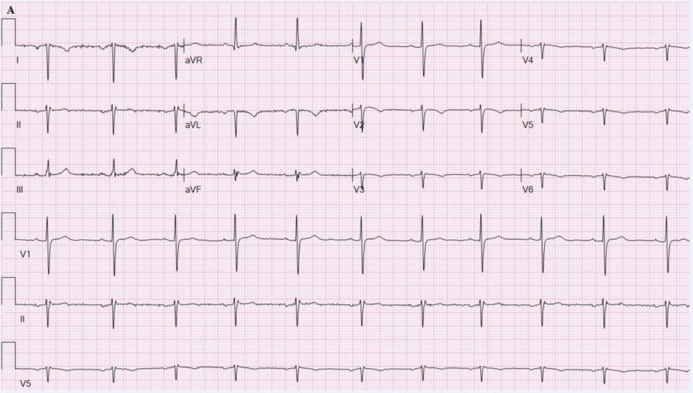 ECG of Situs Inversus Totalis showing right axis deviation, reverse precordial R-wave progression, and inverted P waves in leads I, aVL, and aVR