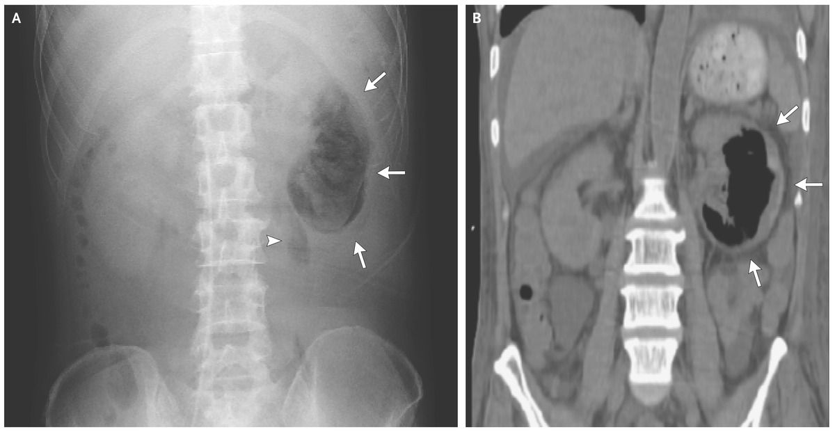 Emphysematous Pyelonephritis on X-Ray and CT