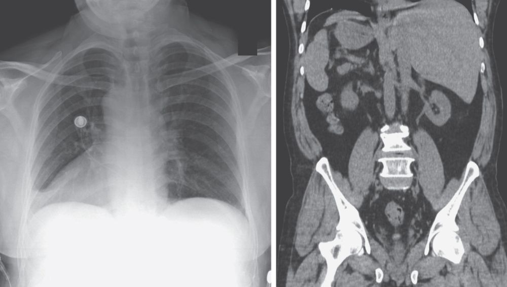 hest X-Ray and CT of Abdomen showing dextrocardia and mirror-image transposition of the abdominal organs indicating situs inversus totalis