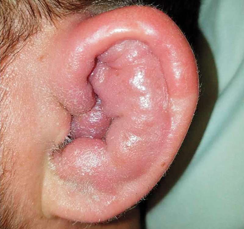 Read more about the article Patient with Left Ear Swelling