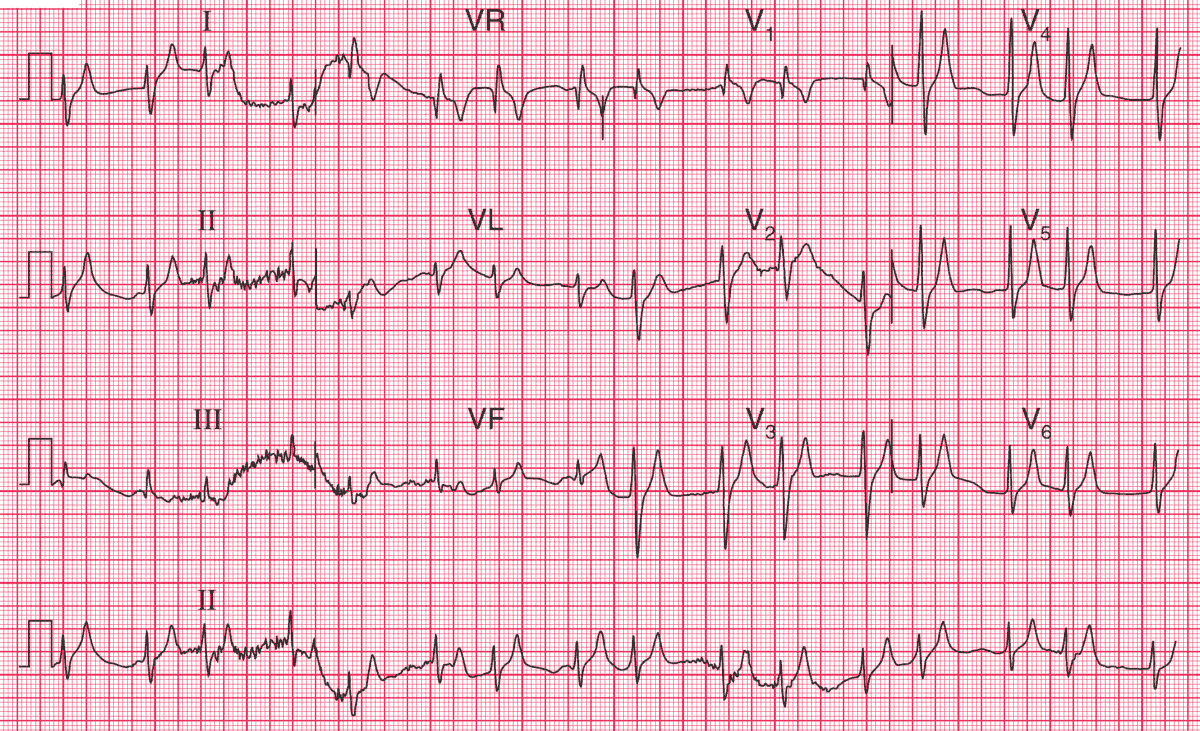 T waves sharply peaked in all leads with P wave widening/flattening indicating Hyperkalaemia