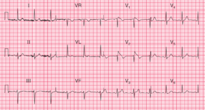 Read more about the article ECG Case 112