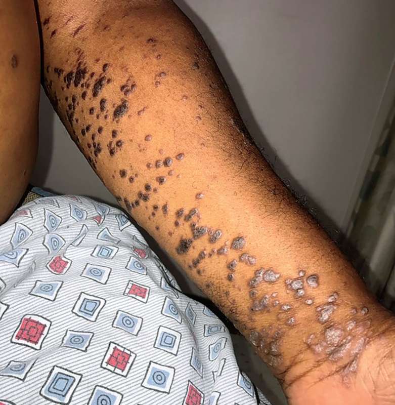Read more about the article Patient with 2-Month History of Pruritic Rash