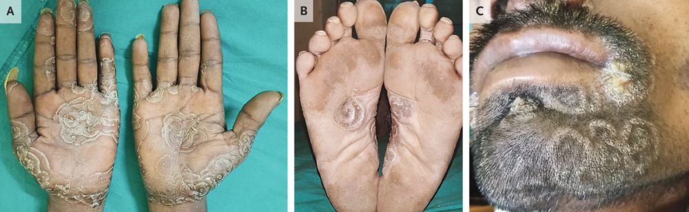Circinate Lesions on Palms, Soles, and Face