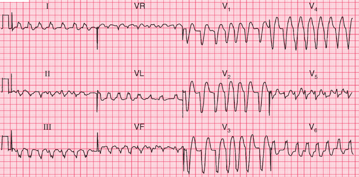 Read more about the article ECG Case 114