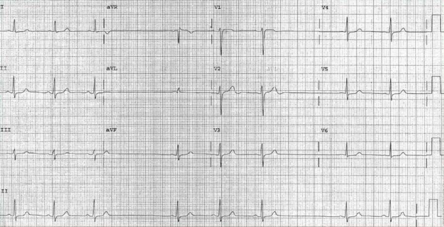 Read more about the article ECG Case 118