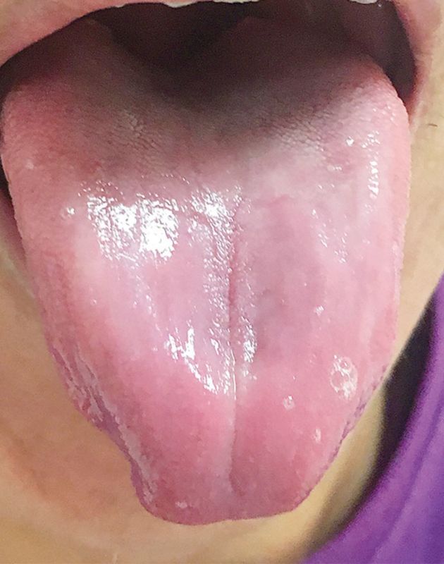 Read more about the article Painful, Smooth, Red Tongue