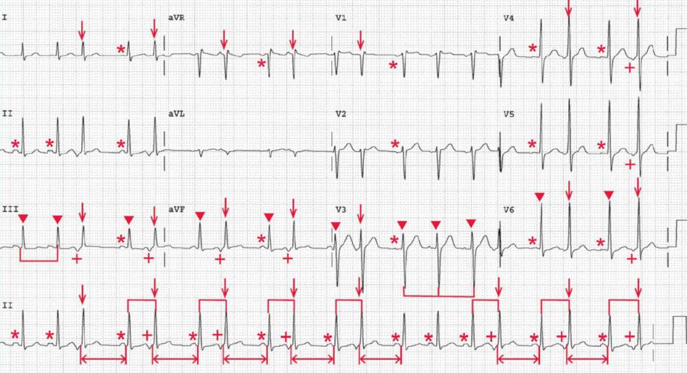 Sinus Tachycardia with frequent premature atrial complexes