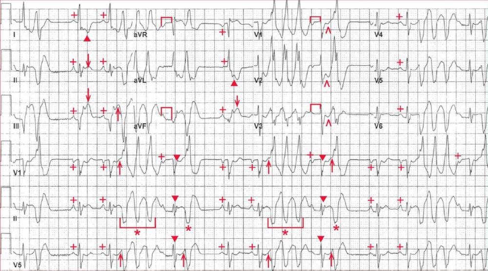 Acute Inferior and Posterior Wall MI and Monomorphic Nonsustained Ventricular Tachycardia