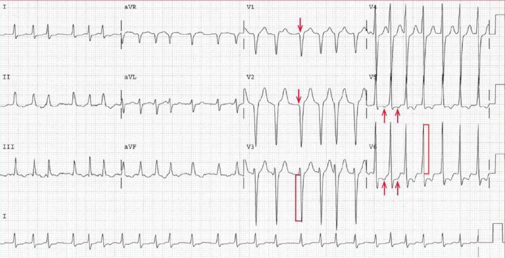 Atrial fibrillation with rapid ventricular response, left ventricular hypertrophy, ST-T wave abnormalities