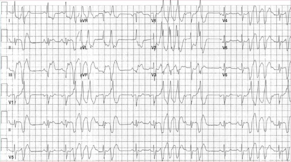 Read more about the article ECG Case 124