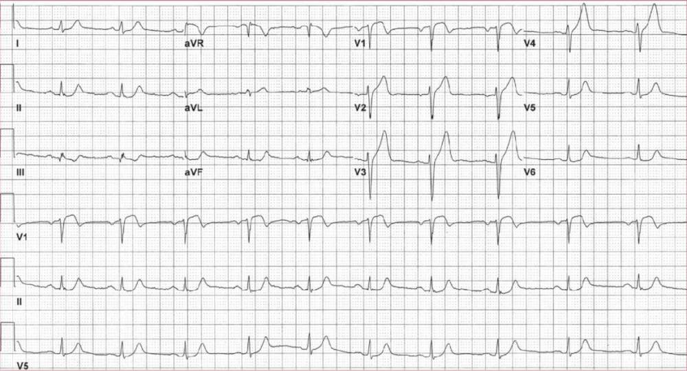 Read more about the article ECG Case 125