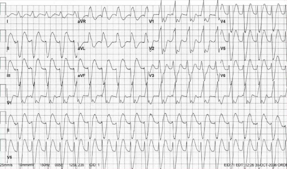 Read more about the article ECG Case 126