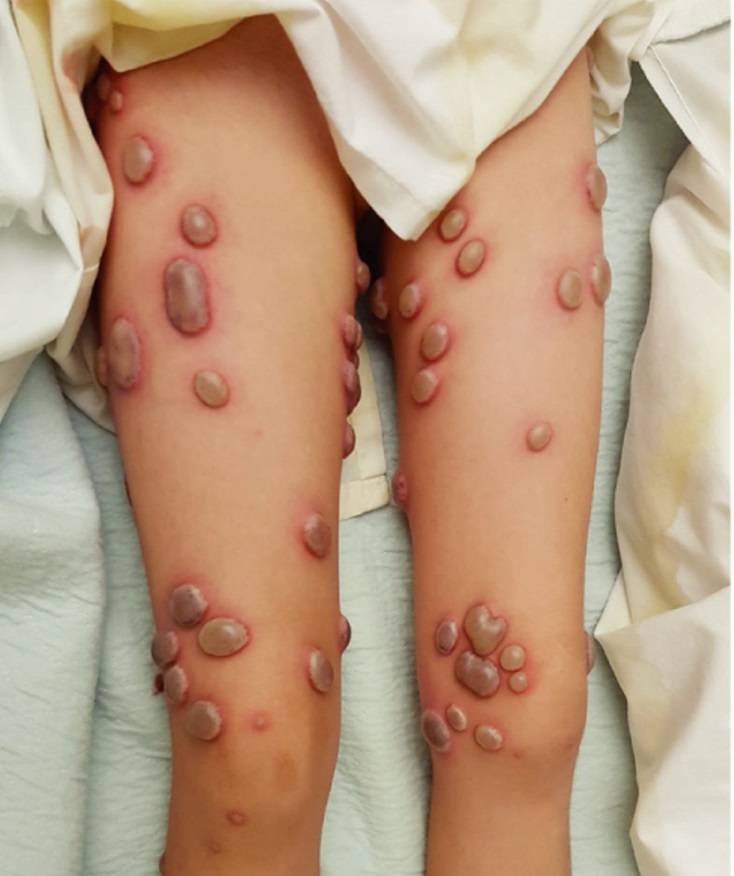 Read more about the article Fever and Painful Blisters on Arms, Legs, and Face