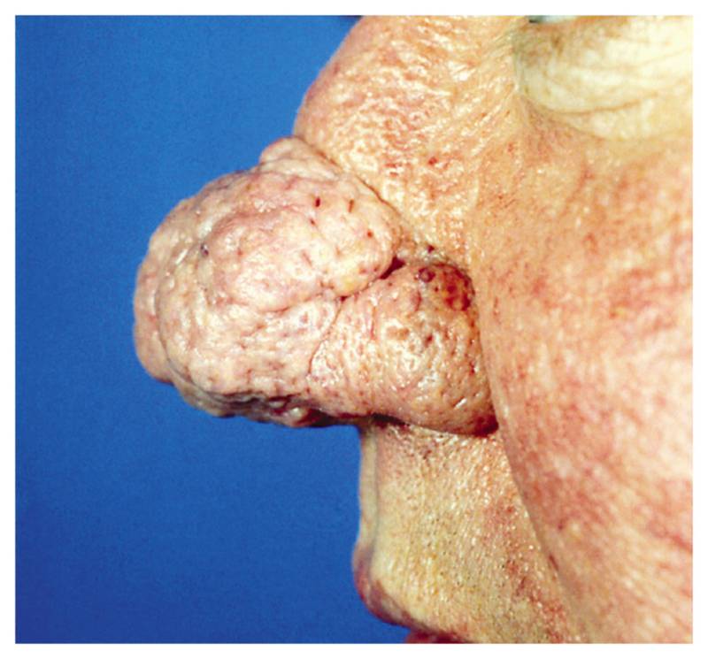 Read more about the article Thickening Skin and Enlargement of the Nose