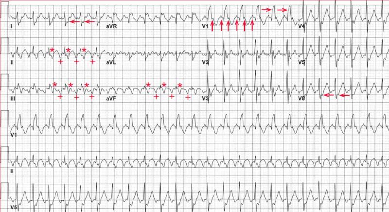 Atrial Flutter with 2:1 Conduction and RBBB