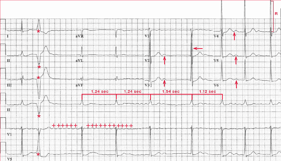 Atrial fibrillation with slow ventricular response, U waves (possible hypokalemia), left ventricular hypertrophy (LVH) 2