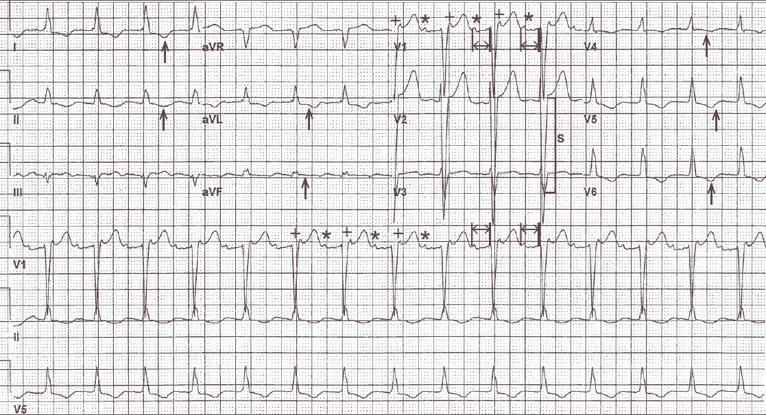 Atrial tachycardia with 2:1 block and LBBB