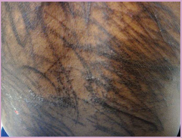 Read more about the article Dark Linear Hyperpigmented Lesions