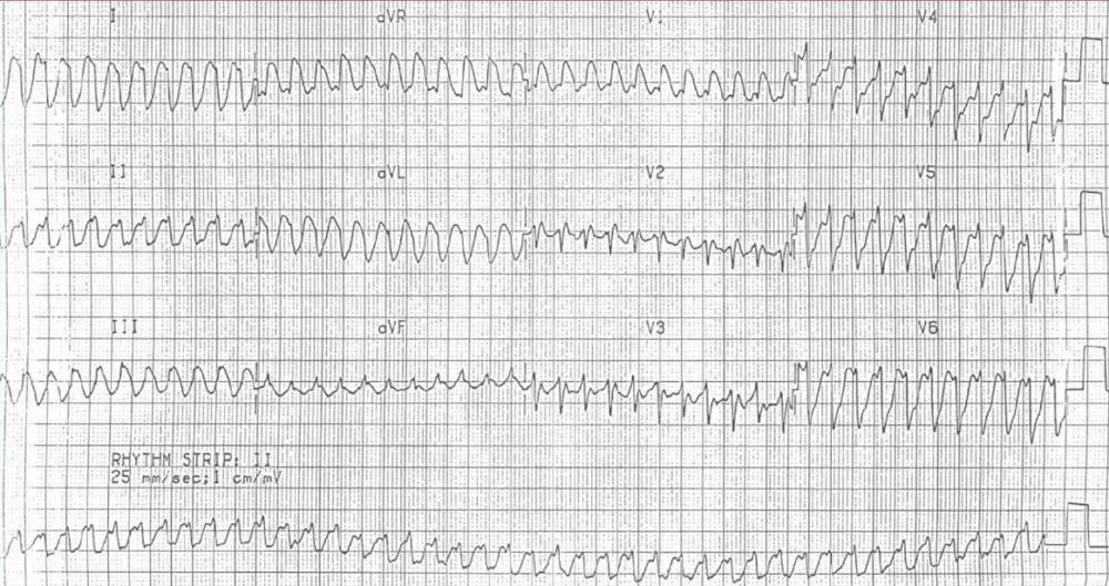 Read more about the article ECG Case 127