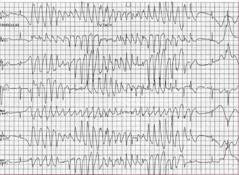 Read more about the article ECG Case 128