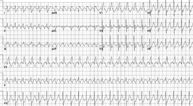Read more about the article ECG Case 130