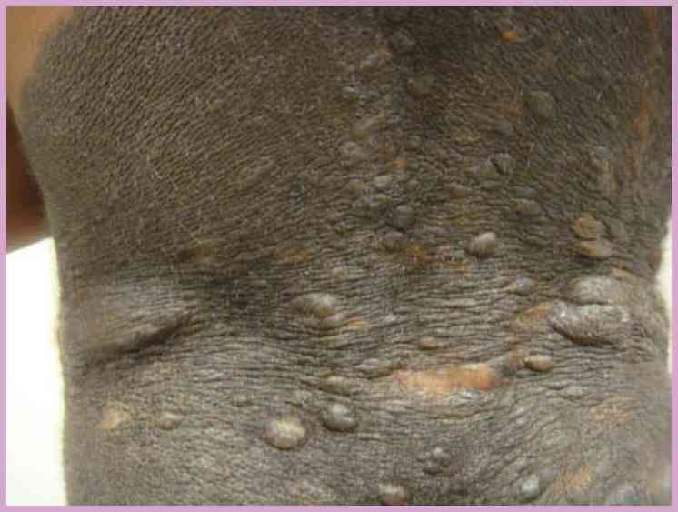Read more about the article Large Dark Hairy Lesion